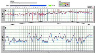 Is Abdominal Fetal Electrocardiography an Alternative to Doppler Ultrasound for FHR Variability Evaluation?